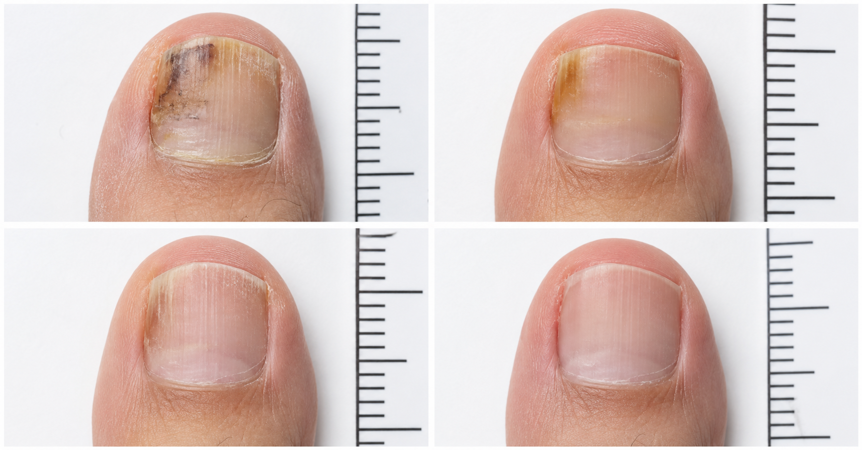 What to Expect When Trying to Stop Nail Picking: A Realistic Timeline
